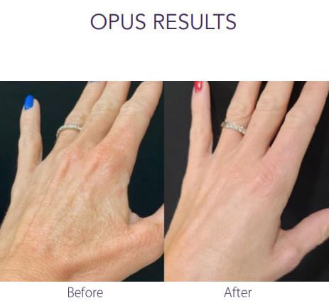 Opus Results Picture 9