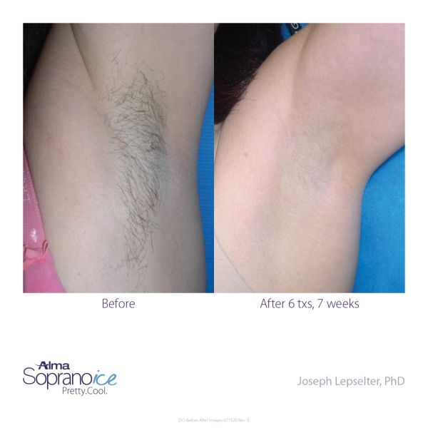 Soprano ICE Before and After B2C 7 Hair Removalweb