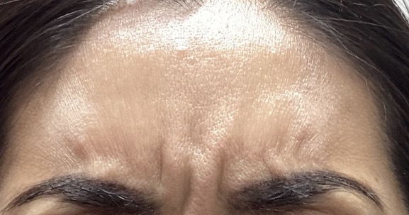 Before Image: Botox - front