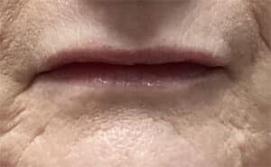 After Image: Lip Filler