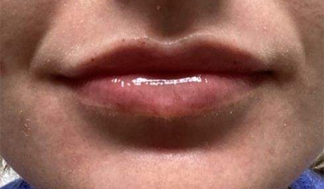 After Image: Lip Filler - front