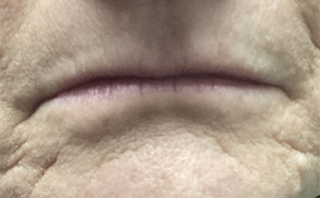 Before Image: Lip Filler - front