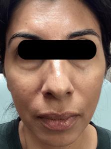 After Image: Opus and ClearLift