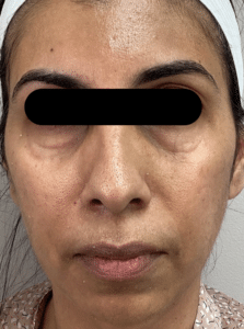 Before Image: Opus and ClearLift