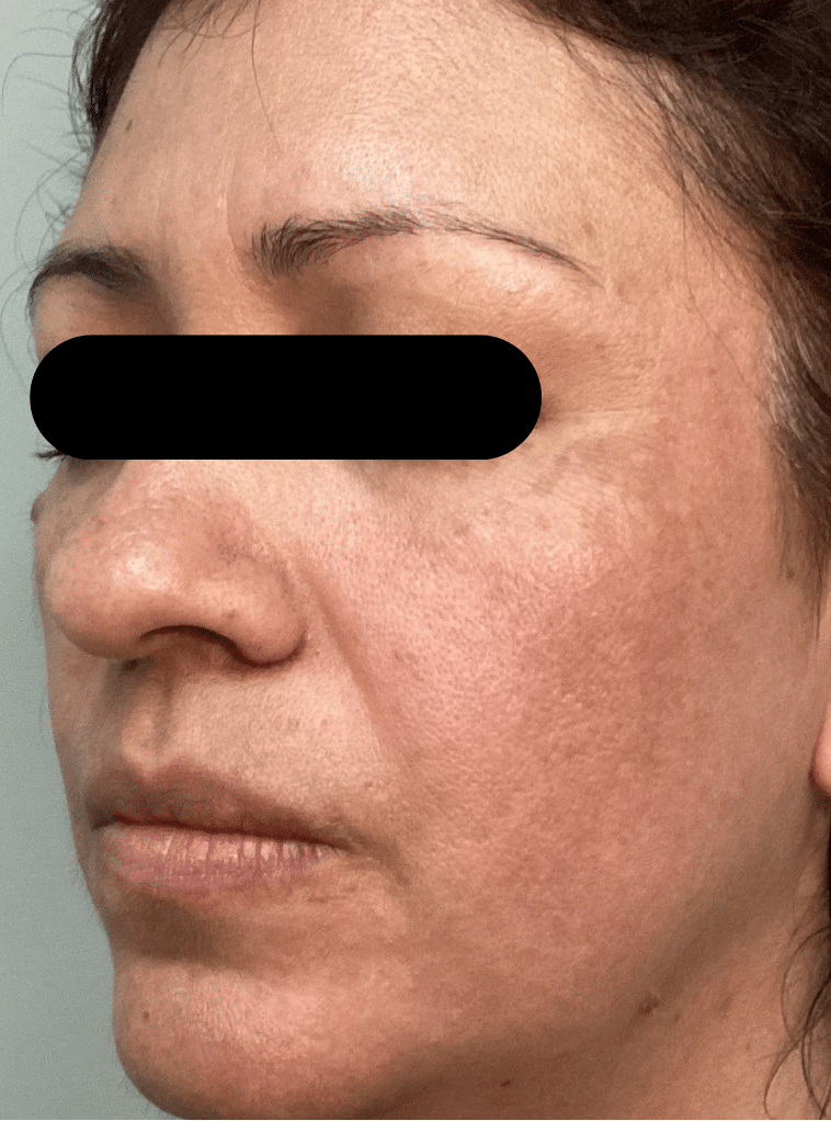 After Image: Chemical Peel - left-front-oblique