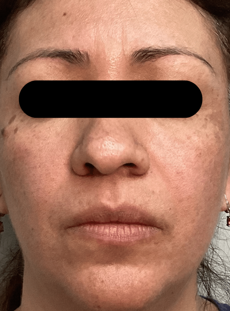 After Image: Chemical Peel - front