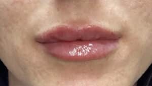 After Image: Lip Filler