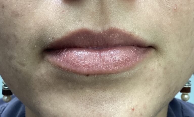 Before Image: Lip Flip - front