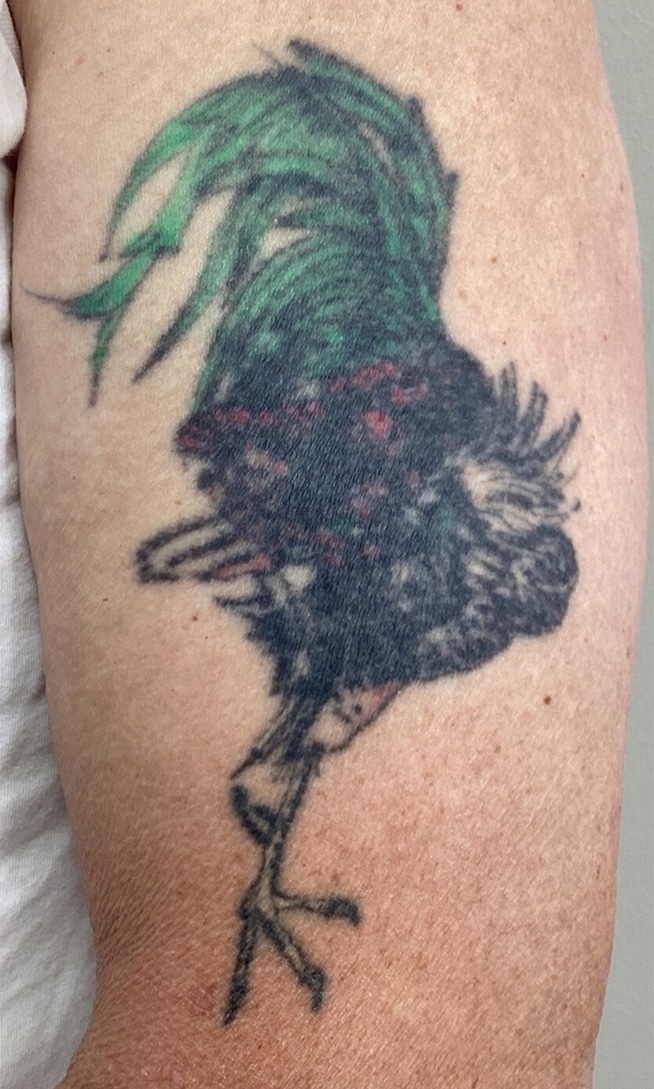 Before Image: Tattoo Removal - front