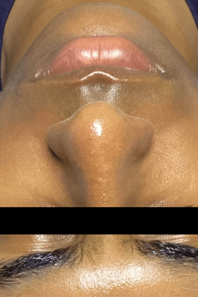 After Image: Hydrafacials - front