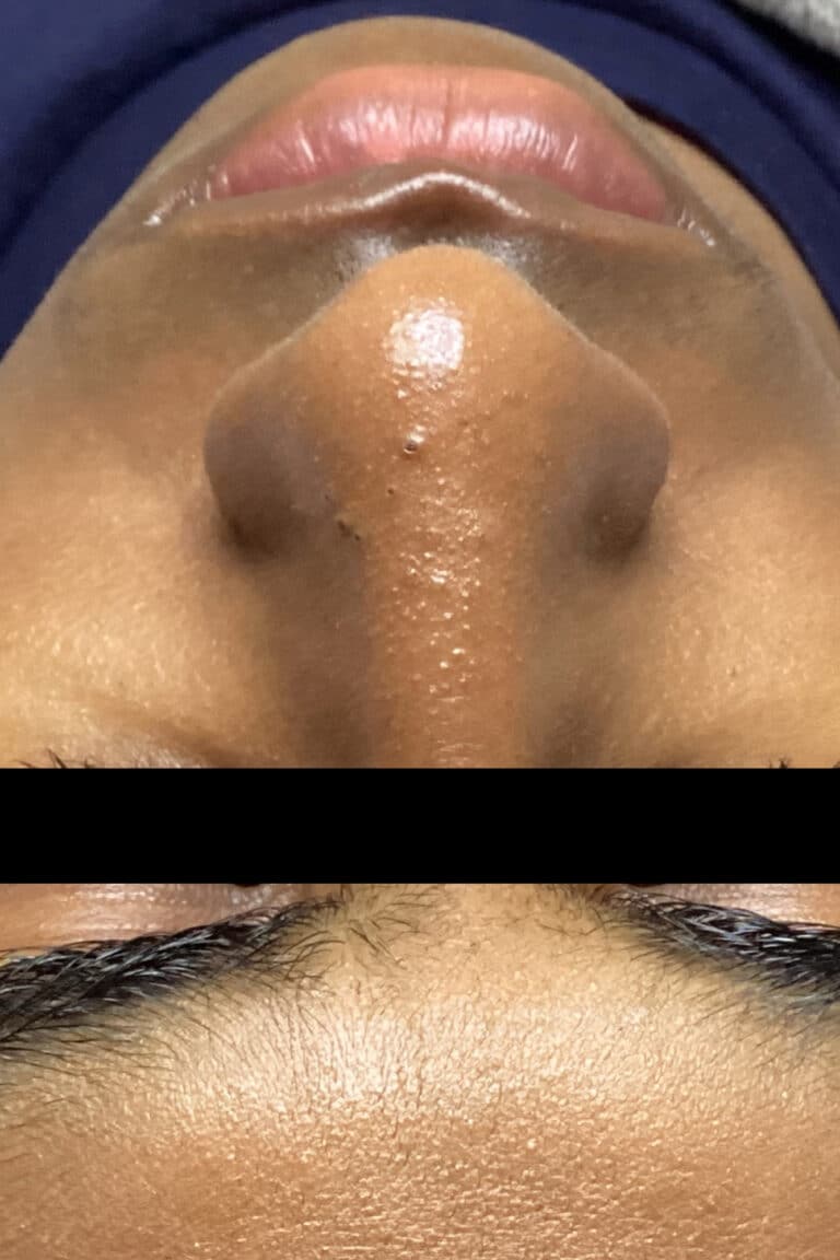 Before Image: Hydrafacials - front