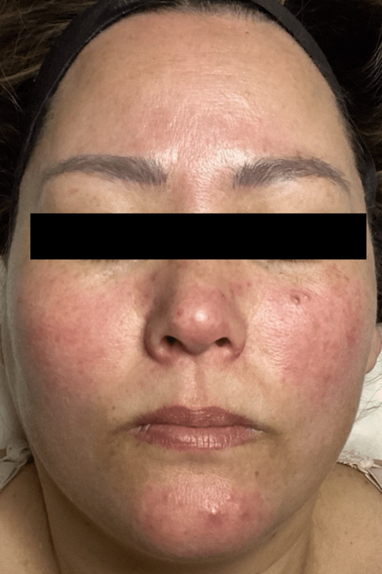 Before Image: Hydrafacials - front