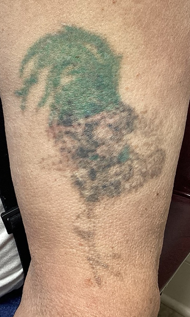 After Image: Tattoo Removal - front