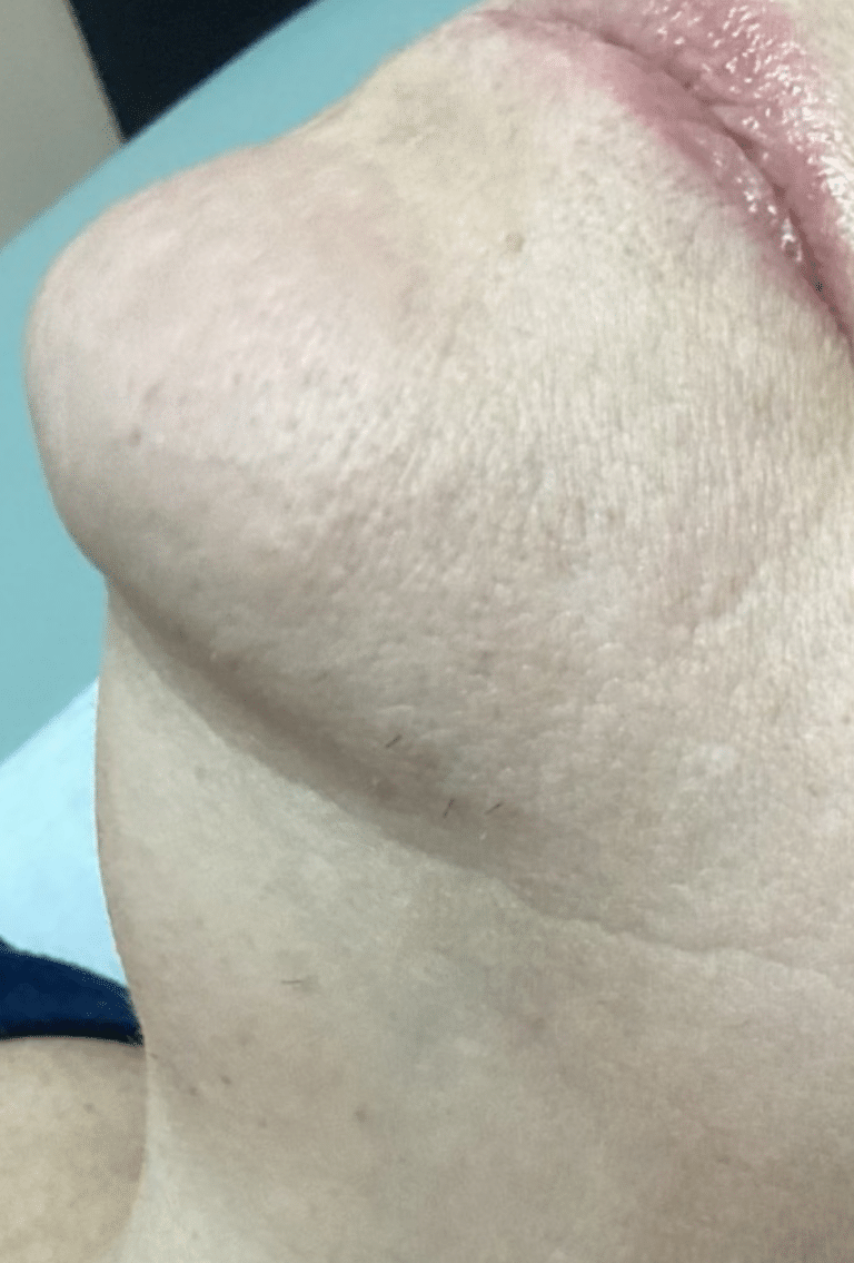 Before Image: Laser Hair Removal - left-front-oblique