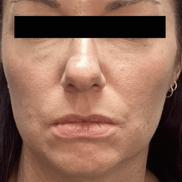 After Image: Fillers - front