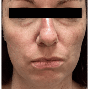 Before Image: Fillers