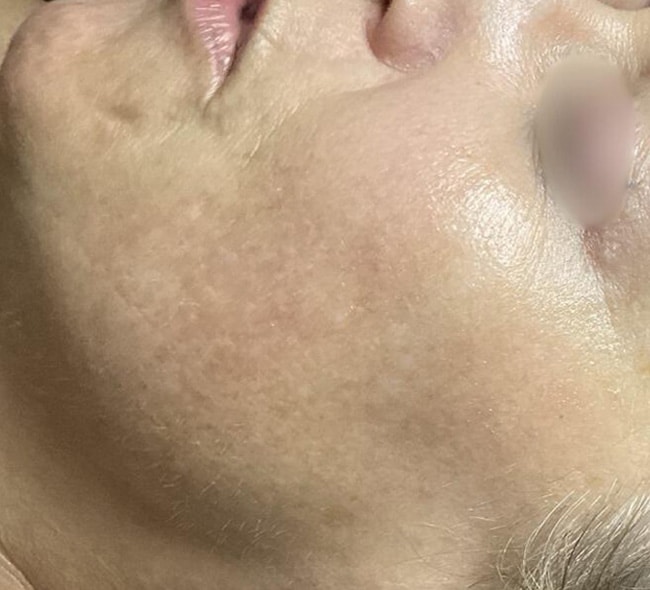 After Image: Hydrafacials - left-side