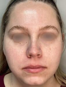 After Image: ClearLift and DyeVL