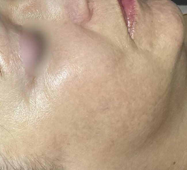 After Image: Hydrafacials - right-side