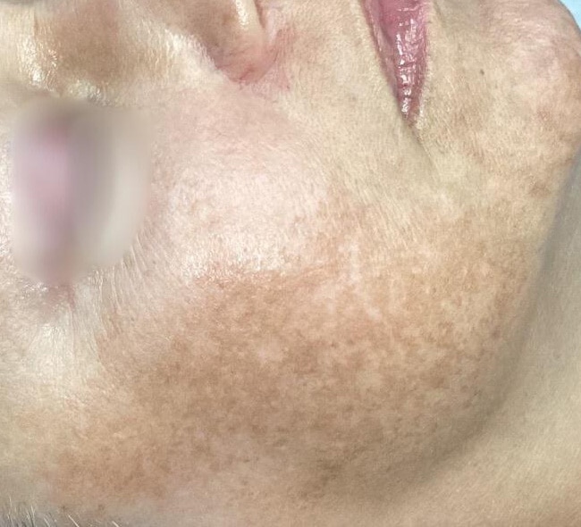 Before Image: Hydrafacials - right-side