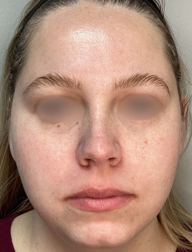 After Image: ClearLift and DyeVL - front
