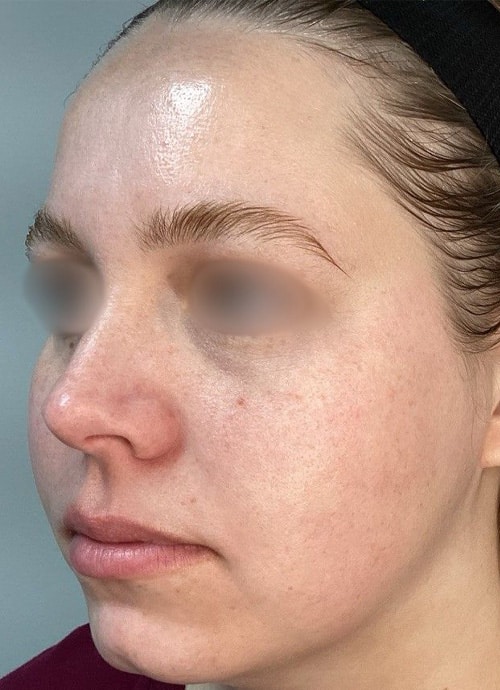 After Image: ClearLift and DyeVL - left-front-oblique