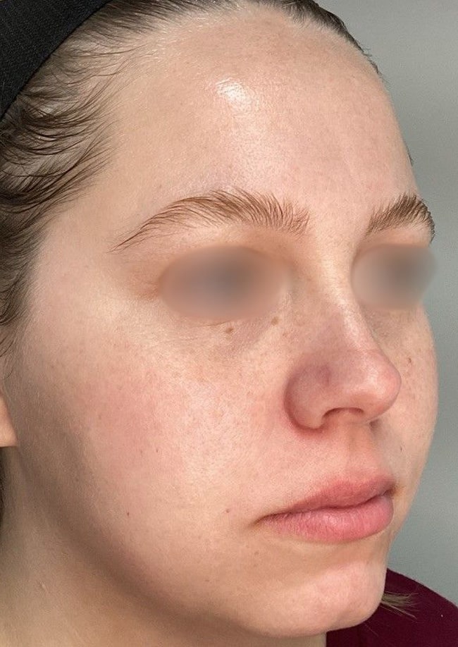 After Image: ClearLift and DyeVL - right-front-oblique
