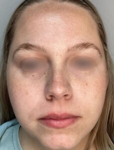 Before Image: ClearLift and DyeVL