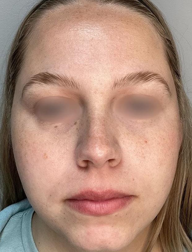 Before Image: ClearLift and DyeVL - front