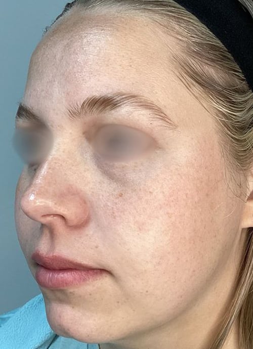 Before Image: ClearLift and DyeVL - left-front-oblique