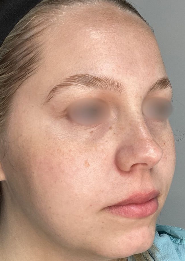 Before Image: ClearLift and DyeVL - right-front-oblique