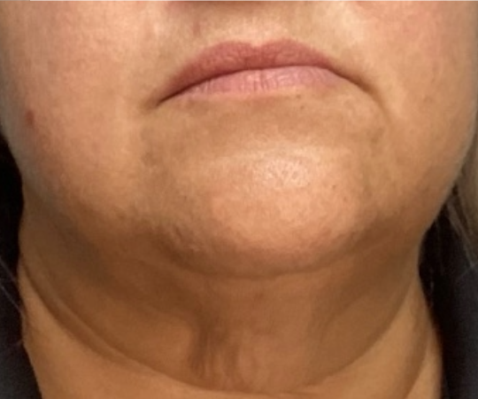 After Image: ClearLift - front