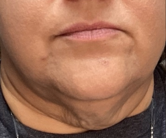 Before Image: ClearLift - front