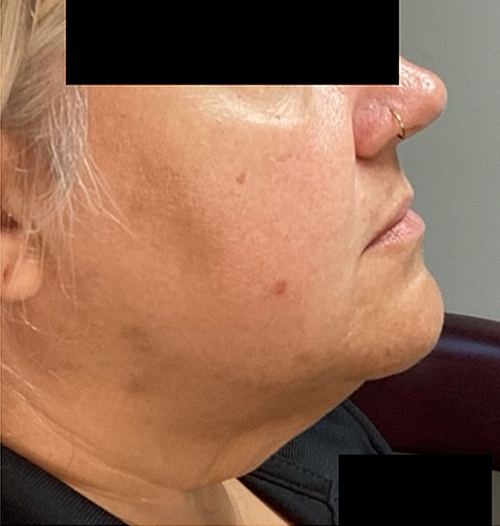 After Image: ClearLift - right-side