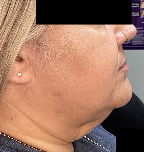 Before Image: ClearLift - right-side