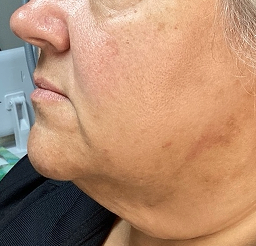 After Image: ClearLift - left-side
