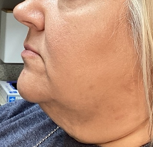 Before Image: ClearLift - left-side