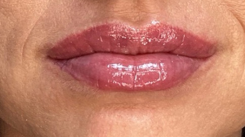 After Image: Lip Filler - front