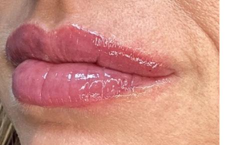 After Image: Lip Filler - left-front-oblique