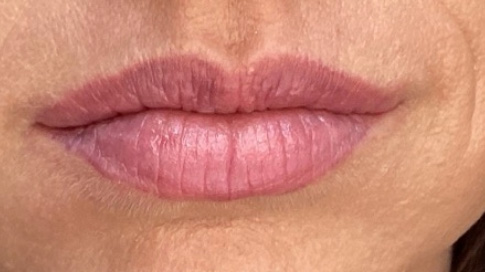 Before Image: Lip Filler - front