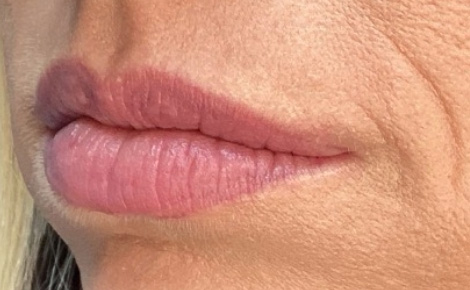 Before Image: Lip Filler - left-front-oblique