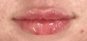 After Image: Lip Filler