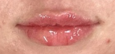 After Image: Lip Filler - front