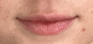 Before Image: Lip Filler