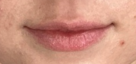 Before Image: Lip Filler - front