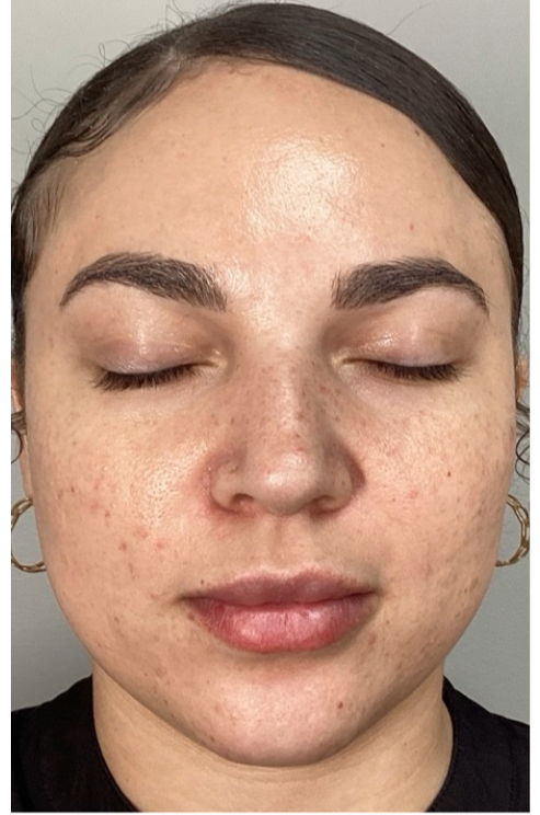 After Image: Opus and ClearLift - front