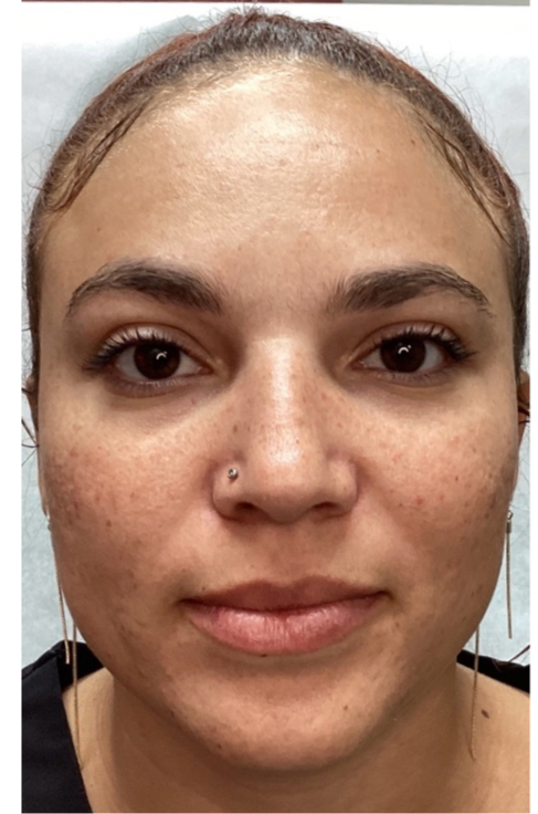 Before Image: Opus and ClearLift - front
