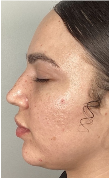 After Image: Opus and ClearLift - left-side
