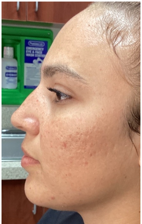 Before Image: Opus and ClearLift - left-side