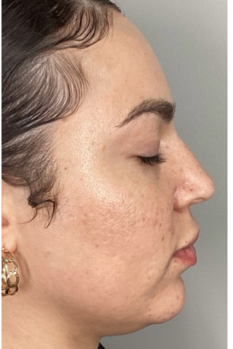 After Image: Opus and ClearLift - right-side